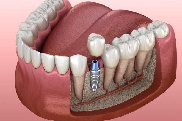 Premolar tooth crown installation over implant abutment. Medically accurate 3D illustration of human teeth and dentures concept