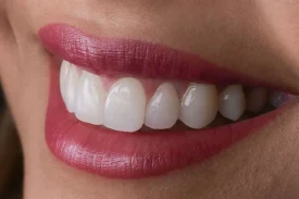 A-close-up-of-a-womans-bright-perfectly-aligned-smile-after-receiving-a-complete-set-of-porcelain-dental-veneers