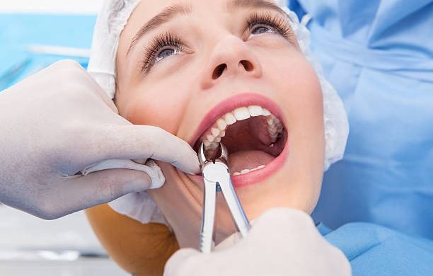 Young woman having tooth removed. Close up picture of a woman mouth with a dentist hand holding extraction forceps