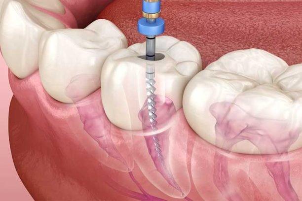 root-canal-procedure